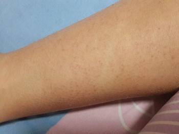 水杨酸治疗毛囊角质化  毛囊角化症 美白祛黄 第2张