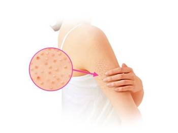 鸡皮肤是什么原因导致的  鸡皮肤 美白祛黄 第2张