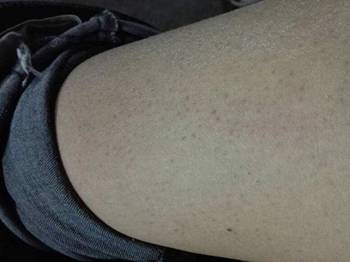 毛囊角化症怎么改善祛除