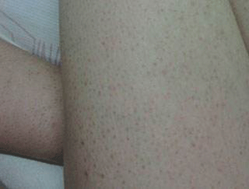 毛囊角化症有什么偏方