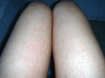 毛囊角化症什么方法治疗好