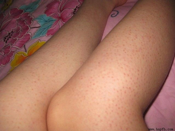 吃什么能消除鸡皮肤