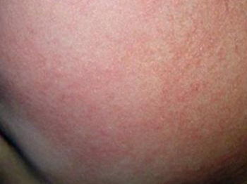 脸上长鸡皮疙瘩一样的东西怎么办