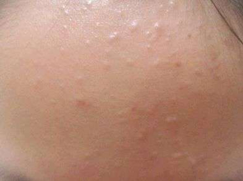 脸上长鸡皮疙瘩一样的东西怎么办  鸡皮疙瘩 美白祛黄 第2张