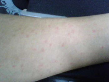 浑身痒起鸡皮疙瘩怎么回事