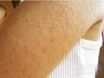 浑身痒起鸡皮疙瘩怎么回事  鸡皮疙瘩 美白祛黄 第2张