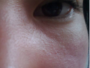 鼻子两侧长鸡皮疙瘩怎么办