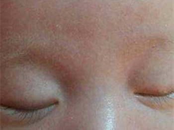 儿童鸡皮肤怎么办如何去除