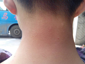 为什么脖子上有鸡皮疙瘩怎么去除