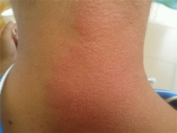 为什么脖子上有鸡皮疙瘩怎么去除 鸡皮疙瘩 美白祛黄 第2张 为什么脖子上有鸡皮疙瘩怎么去除 鸡皮疙瘩 美白祛黄 第2张