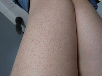 醋可以去鸡皮肤吗方法是什么