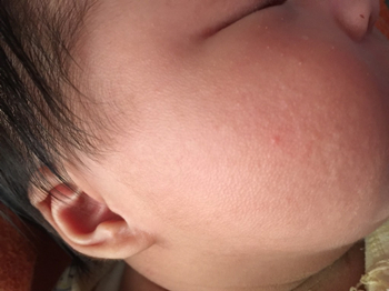 孩子皮肤粗糙鸡皮疙瘩一样，什么原因怎么办