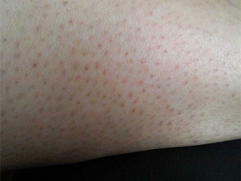 日本小林去鸡皮使用方法 去鸡皮肤 美白祛黄 第4张 日本小林去鸡皮使用方法 去鸡皮肤 美白祛黄 第4张