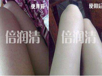 倍润清去鸡皮肤有用吗  去鸡皮肤 倍润清 美白祛黄 第2张