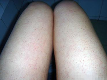 去除鸡皮肤民间小偏方，去鸡皮肤简单方法