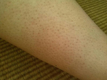 鸡皮肤怎么消除最有效，去除鸡皮肤小窍门妙招