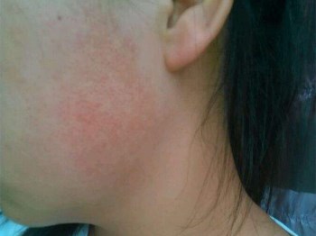 脸部毛周角化症怎么治，四种解决方法