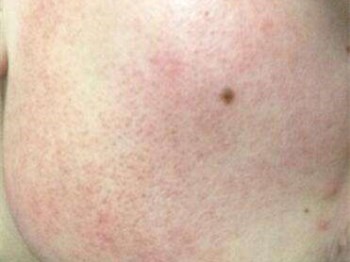 脸部毛周角化症怎么治，四种解决方法  脸部 美白祛黄 第2张