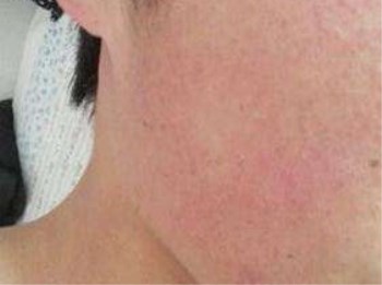 脸部毛周角化症怎么治，四种解决方法  脸部 美白祛黄 第3张