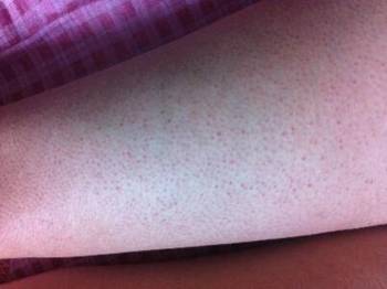 毛囊角化症是什么病