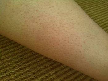 鸡皮疙瘩用什么沐浴露