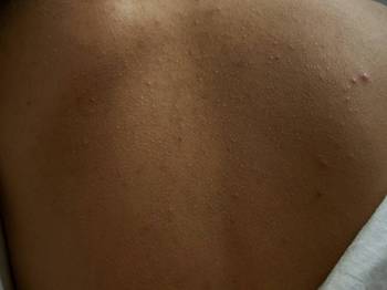 背上起鸡皮疙瘩痒怎么治疗