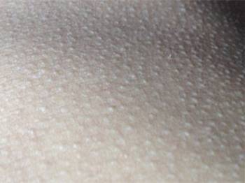 大腿内侧鸡皮疙瘩很痒怎么回事  鸡皮疙瘩 美白祛黄 第2张