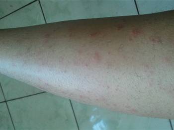 大腿内侧鸡皮疙瘩很痒怎么回事  鸡皮疙瘩 美白祛黄 第4张