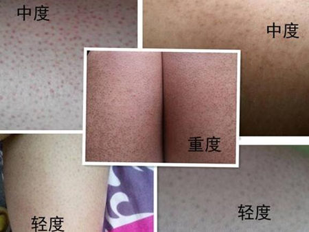 激光去鸡皮肤多少钱,能彻底去除吗 激光 美白祛黄 第2张 激光去鸡皮肤多少钱,能彻底去除吗 激光 美白祛黄 第2张