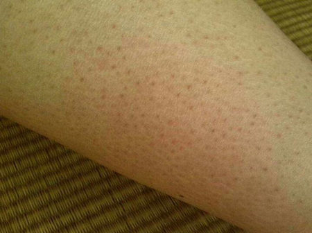 激光去鸡皮肤多少钱,能彻底去除吗 激光 美白祛黄 第3张 激光去鸡皮肤多少钱,能彻底去除吗 激光 美白祛黄 第3张