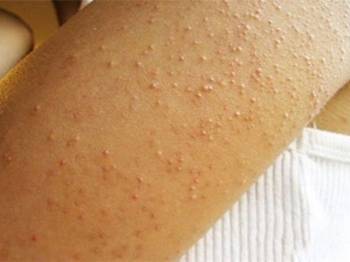 激光治疗毛周角化症能根治吗  毛周角化症 美白祛黄 第2张