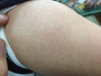 激光治疗毛周角化症能根治吗  毛周角化症 美白祛黄 第3张