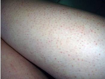 有没有毛周角化的姐妹,去鸡皮经验分享 毛周角化症 美白祛黄 第2张 有没有毛周角化的姐妹,去鸡皮经验分享 毛周角化症 美白祛黄 第2张