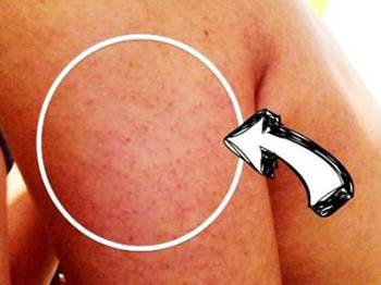 鸡皮肤吃维生素a有用吗  去鸡皮肤 美白祛黄 第2张