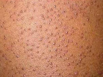 毛周角化症是鸡皮肤么