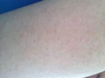 毛周角化症是鸡皮肤么  皮肤 美白祛黄 第2张