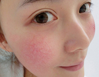 哪款护肤品修复高原红比较好