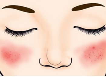 怎样修复敏感肌肤脸上的红血丝