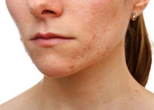 酒粕面膜用了脸**辣的正常吗，哪些人不适合用这面膜  酒粕面膜 美白祛黄 第5张