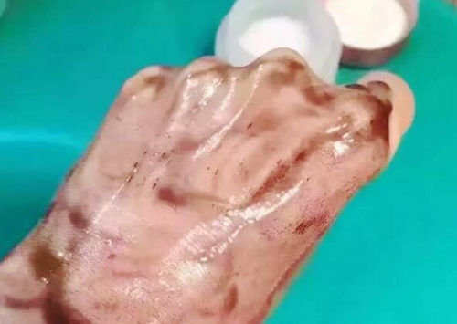 芭妮兰卸妆膏过敏症状怎么消除  芭妮兰 卸妆膏 过敏 美白祛黄 第3张