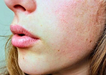 皮肤屏障修复好的表现都是哪些