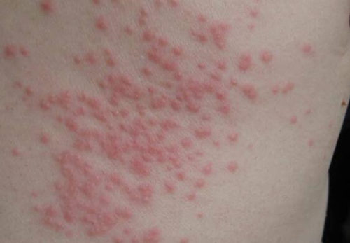 过敏性皮疹自己会好吗，一般多久会好