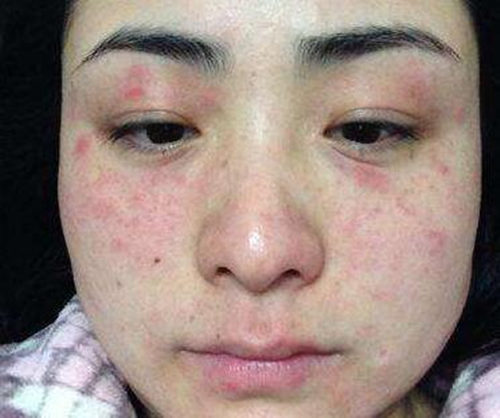 过敏性皮疹自己会好吗，一般多久会好  皮疹 过敏 美白祛黄 第2张