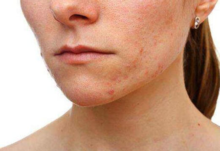 脸过敏用扑尔敏敷脸管用吗  过敏 扑尔敏 敷脸 美白祛黄 第2张