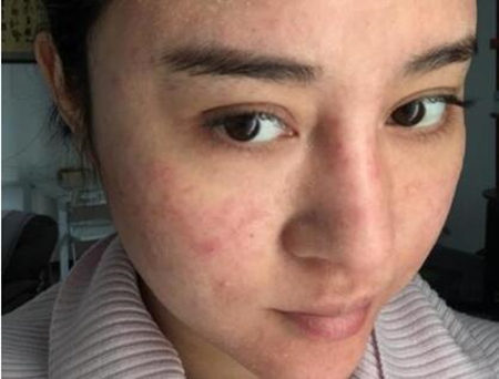 激素脸皮肤发黑发暗怎么办，推荐几个小方法改善