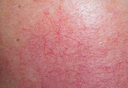 如何测试是否为敏感肌，从这五点来判断  敏感肌 美白祛黄 第2张