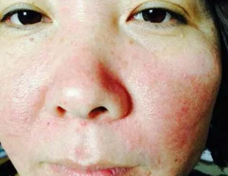 如何测试是否为敏感肌，从这五点来判断  敏感肌 美白祛黄 第3张