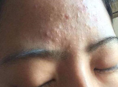 过敏肌皮肤不平滑怎么办，凹凸有颗粒护理方法总结