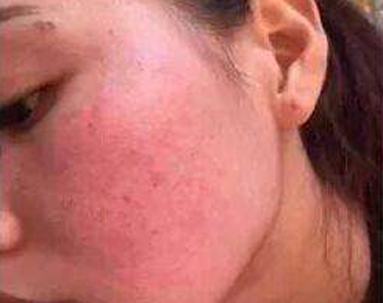 干性敏感肌症状，教你正确认识干性敏感肌  干性 敏感肌 美白祛黄 第4张