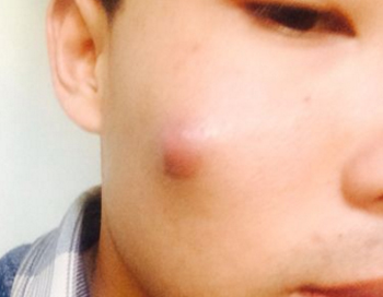 脸上长大疙瘩里面硬的，非比寻常的大疙瘩  疙瘩 硬的 美白祛黄 第2张